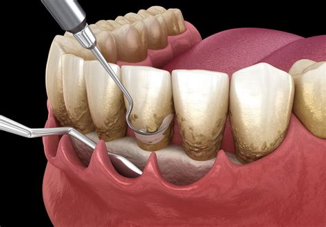 Periodontal Management .